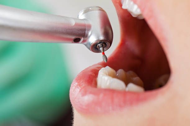 Best Emergency Dentist for Lost Fillings or Crowns in Pinckneyvle, IL